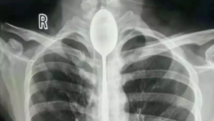 Dieses Röntgenbild macht sprachlos: Mann hat ein Jahr lang einen Löffel im Hals