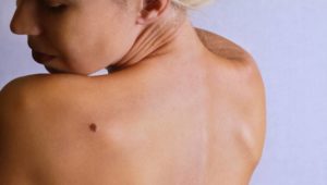Hautkrebs erkennen: Ist mein Leberfleck gefährlich?
